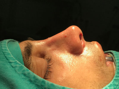 Хирургия носовой кости